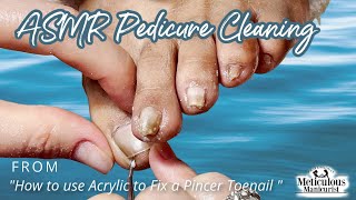 👣ASMR Pedicure Cleaning💆‍♀️How to use Acrylic to Fix a Pincer Toenail Tutorial👣 [upl. by Aruasor]