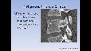 Spondylolysis  Spondylolisthesis Learning Quiz [upl. by Gnahc133]