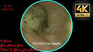 THE MAN  Liquid Ear Wax Removal [upl. by Nerag]