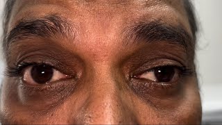 Myasthenia Gravis eye signs [upl. by Ludwigg]