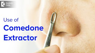 Comedone Extractor for Blackhead Whitehead at homeIs it safe Dr Rajdeep Mysore Doctors Circle [upl. by Llednahs]