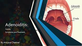 Adenoiditis PowerPoint presentation [upl. by Quill]