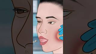 ASMR Dimple piercing infection treatment P1asmr animation satisfying trending shorts [upl. by Noyar]