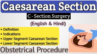 Cesarean section in hindi  Lower segment caesarean section in hindi [upl. by Asina]