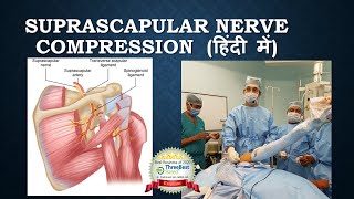 कंधे की नस दब जाना Suprascapular Nerve Compression Hindi [upl. by Seditsira]