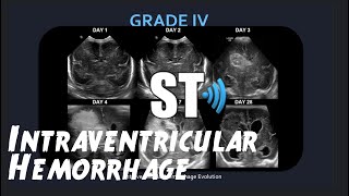 Intraventricular Hemorrhage Neonatal IVHBrain Bleed [upl. by Ashling886]