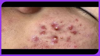 Blackhead Removal and Acne Treatment Satisfying Extraction 2024 [upl. by Fiertz]