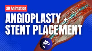 Angioplasty and Stent Placement  3D Animation [upl. by Taylor]