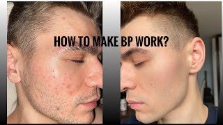 Why is Benzoyl Peroxide not working Short contact therapy  How I cleared up my acne [upl. by Loftus731]