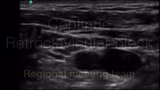 Continue Retroclavicular Brachial Plexus block [upl. by Malcom]