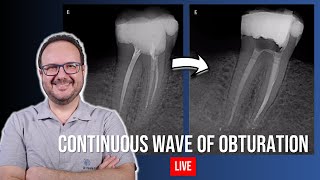 Obturation with Continuous Wave of Condensation on Tooth 46  Part 2 [upl. by Aztilay]