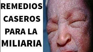 Cómo tratar y curar la “Miliaria” O Sarpullido con remedios caseros [upl. by Rosalyn]