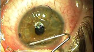 IntraLase Lasik Surgery  Right Eye [upl. by Airehs882]