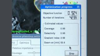 Leksell GammaPlan Inverse Planning [upl. by Trinee]