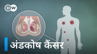 नौजवान पुरुषों को अंडकोष कैंसर का खतरा Testicular cancer – a risk for young men [upl. by Delaryd]