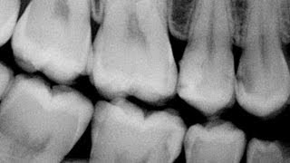 Bitewing Xray tips [upl. by Mollee]