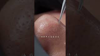 Take good care of your skin during the season change immersiveskincare blackheads asmr facespa [upl. by Terrijo149]