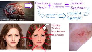 Carcinoid syndrome  Symptoms and treatment Carcinoid Heart Disease [upl. by Alyakcim]