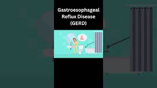 Gastroesophageal Reflux Disease GERD [upl. by Aivila]