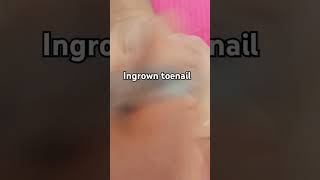 Ingrown toenail nailspolished pedicure ingrown [upl. by Tews393]