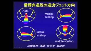 「心エコーでＭＲはこう見る（形態と病因）ＴＴＥ」尾辻 豊先生 [upl. by Tremayne]