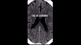 TAC de cerebro NORMAL Estructuras que pueden observarse [upl. by Harty122]