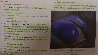 Keratoconjunctivitis Sicca  EYE [upl. by Atilahs]