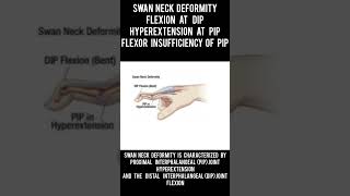 Swan neck deformity swan neck deformity medical medicalconditions students learner pti bpt [upl. by Munford]