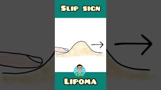 Slip sign in Lipoma  Surgery  shorts [upl. by Carey]