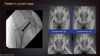 Sports Medicine Case 41 10yearold female Young Athlete Slipped Up by Hip Pain [upl. by Atteuqehs]