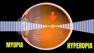 Myopia and Hyperopia [upl. by Jimmy]