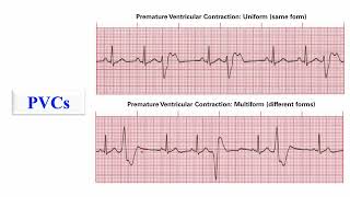 ECG interpretation Heart arrhythmias [upl. by Dazraf738]