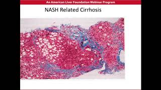 NASH Disease Overview [upl. by Yhtuv782]