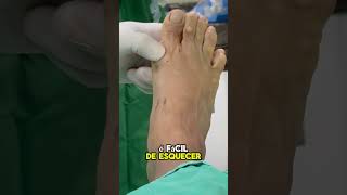 Joanete na Cirurgia Percutânea joanete halluxvalgus bunions bunion [upl. by Yxor443]