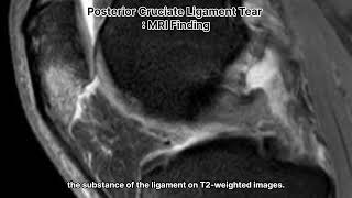 Posterior Cruciate Ligament PCL tear  MR Finding [upl. by Milon]