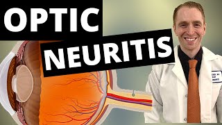 Optic Neuritis Symptoms Diagnosis and Treatment [upl. by Einnod252]