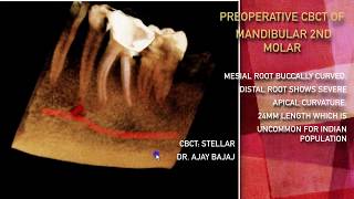 MANDIBULAR 2ND MOLAR WITH CURVED CANALS [upl. by Ronn]