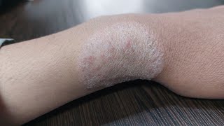 Plaque psoriasis  Different photos  Symptoms diagnosis treatment amp prevention [upl. by Noell]