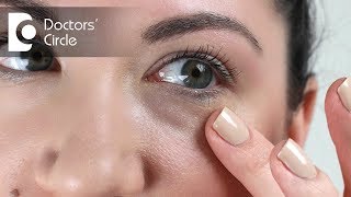 Causes of long lasting red splotcheses under the eyes  Dr Rasya Dixit [upl. by Akimot908]