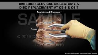 Anterior Cervical Discectomy amp Disc Replacement at C56 amp C67  Medical Animation [upl. by Elorac481]