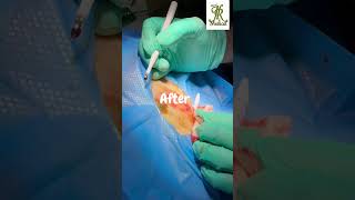 Skin lesion removal with curettage [upl. by Eillit]