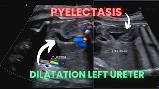 Ultrasound Pregnancy fetal pyelectasis and dilatated ureter Diagnosis criteria [upl. by Inihor]