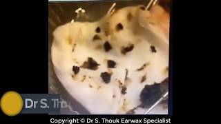 Earwax Removal Extraction Cholesteatoma surgery Part 1 [upl. by Anirbas60]