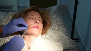 Juvederm injections to nasolabial folds [upl. by Ynor]