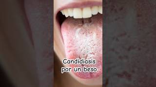 ¡Alerta Puedes contraer candidiasis por un beso  Dr William Guerrero medicina shorts [upl. by Einal]