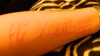 My Dermatographia [upl. by Amador]