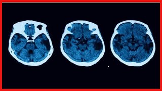 Posteriore kortikale Atrophie Diagnose und Behandlung [upl. by Bose]