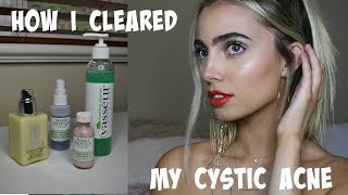 HOW I CLEARED MY CYSTIC ACNE Skincare Routine amp Tips [upl. by Jolenta808]