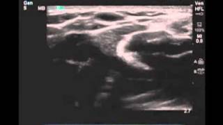 How To Peripheral Arm Veins for Vascular Access Scanning Technique Video [upl. by Herrington]