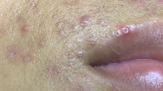 Blackheads ​⁠BYoungSpa [upl. by Gavrilla]